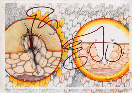 Zeichnung 'Versenkte Intrakutannaht, 1. Schritt', 2005